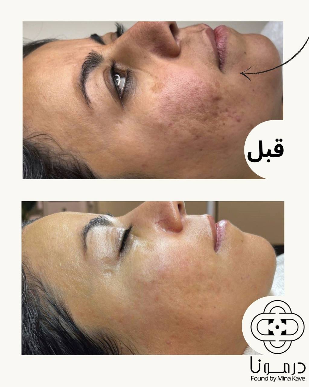 نمونه قبل و بعد درمان لک صورت