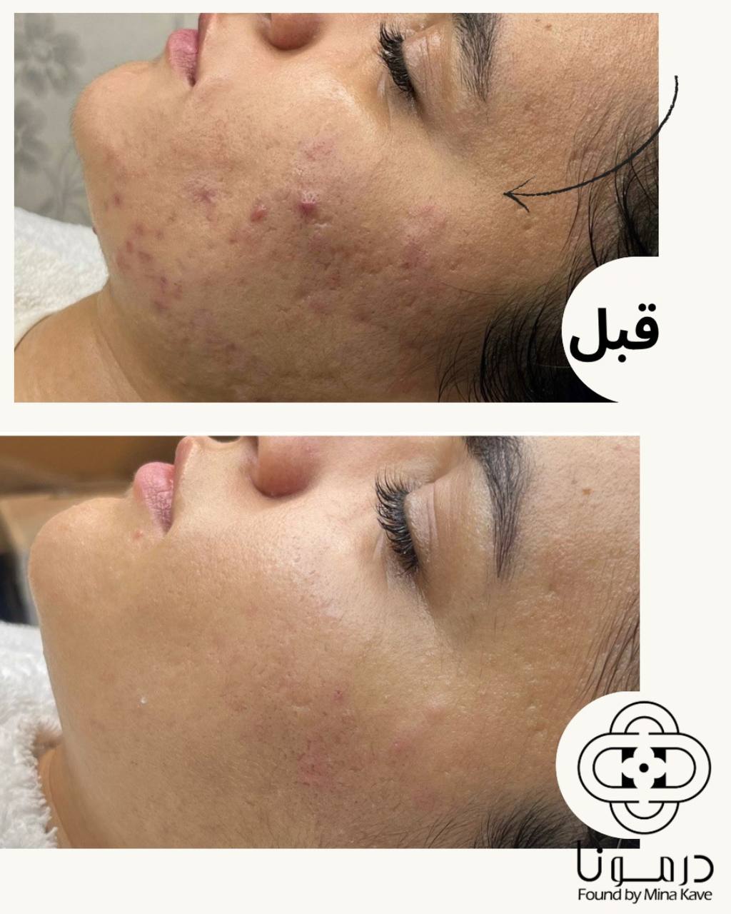 نتیجه درمان جوش و آکنه، قبل و بعد — درمونا شیراز