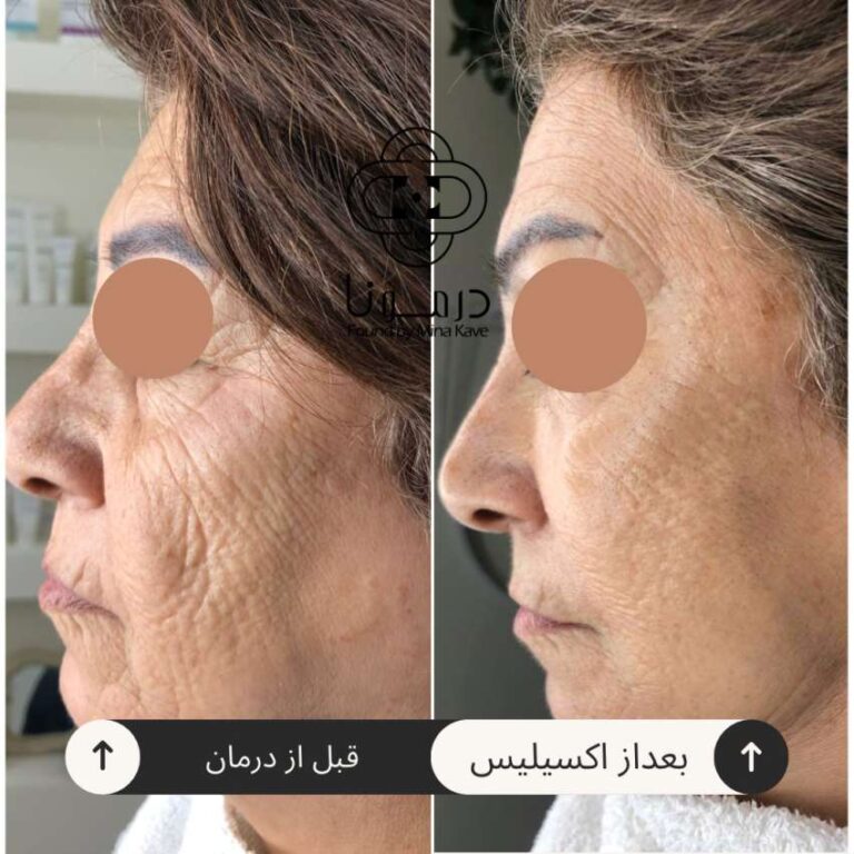 جوان‌سازی صورت خانم ۶۰ ساله، قبل و بعد — درمونا شیراز