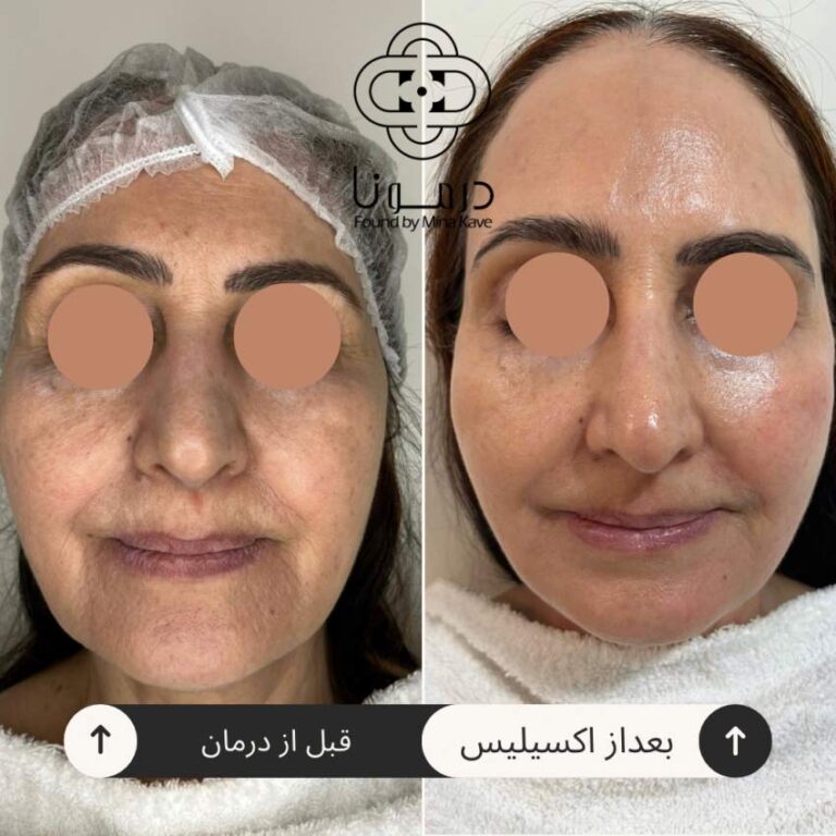 جوان‌سازی صورت خانم ۶۵ ساله، قبل و بعد — درمونا شیراز