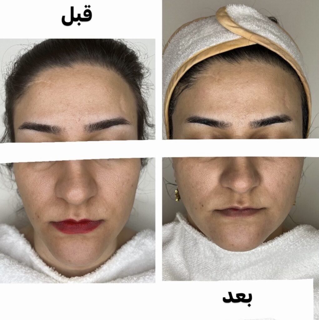 عکس قبل و بعد لیفت صورت بعد از لاغری | درمونا کلینیک