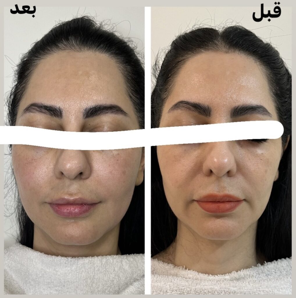 عکس قبل و بعد لیفت صورت بعد از لاغری | درمونا کلینیک
