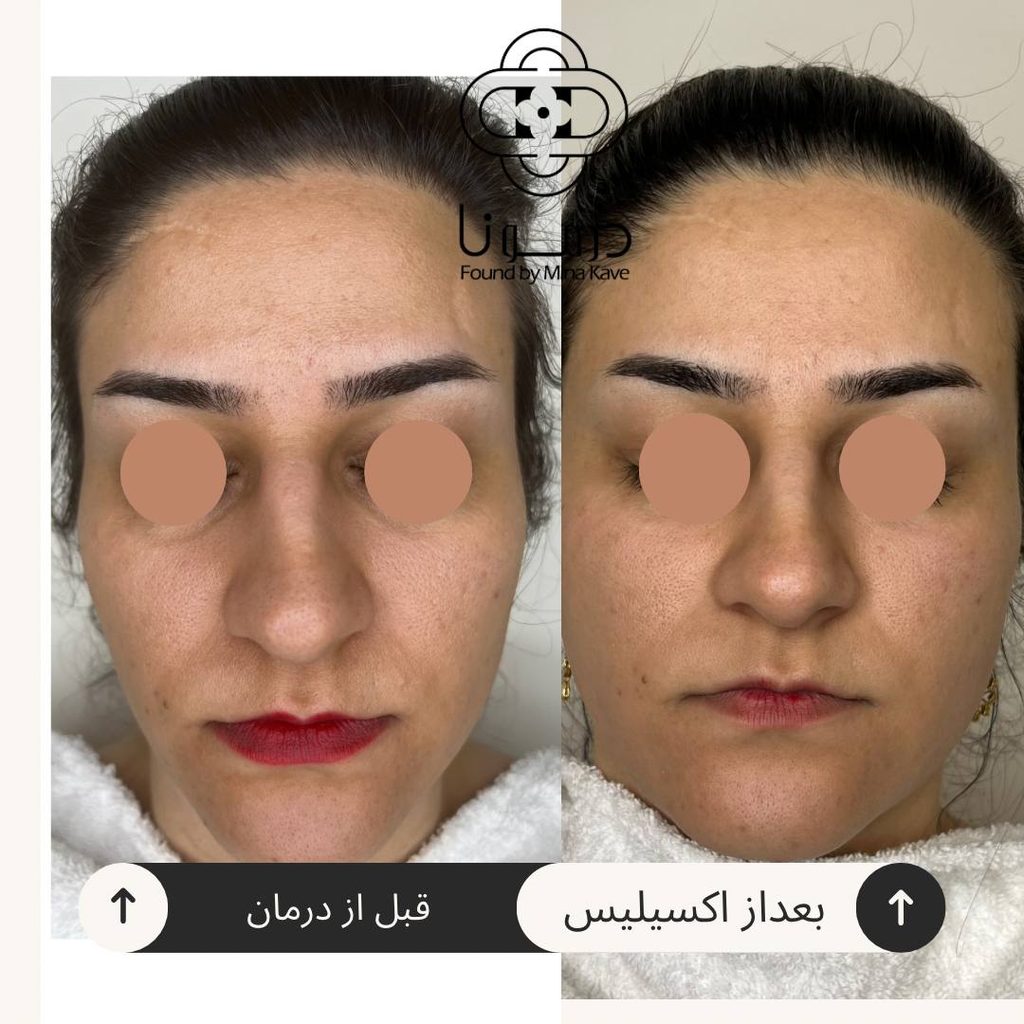 جوانسازی پوست شیراز-درمونا